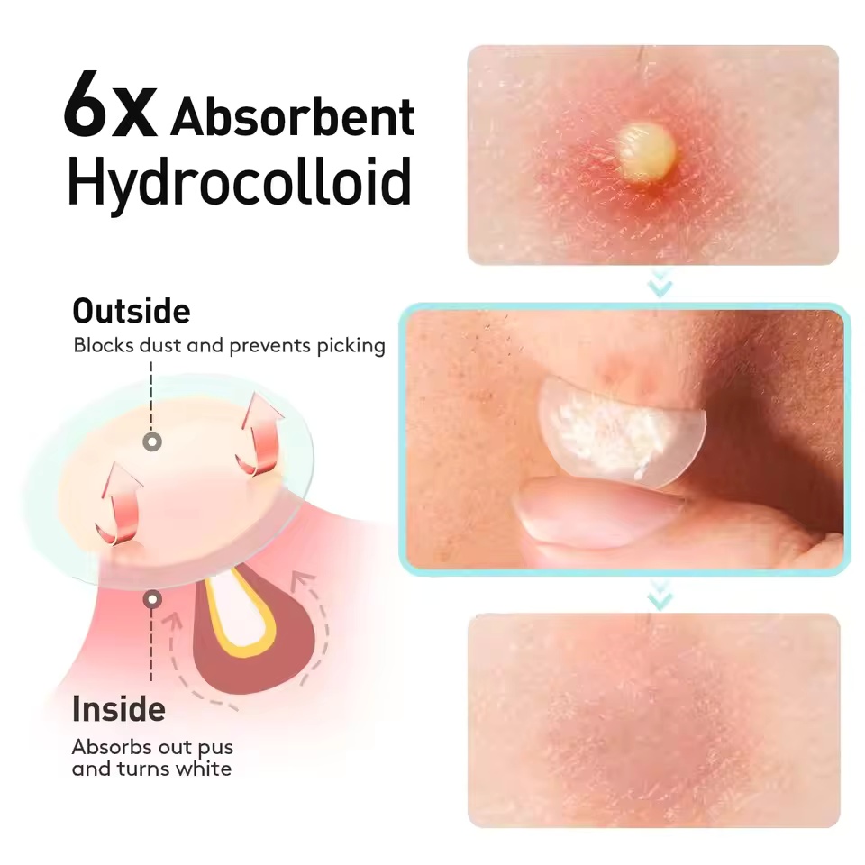 360 stuks/doos acnepleisters - - Face Oil recensie en prijs